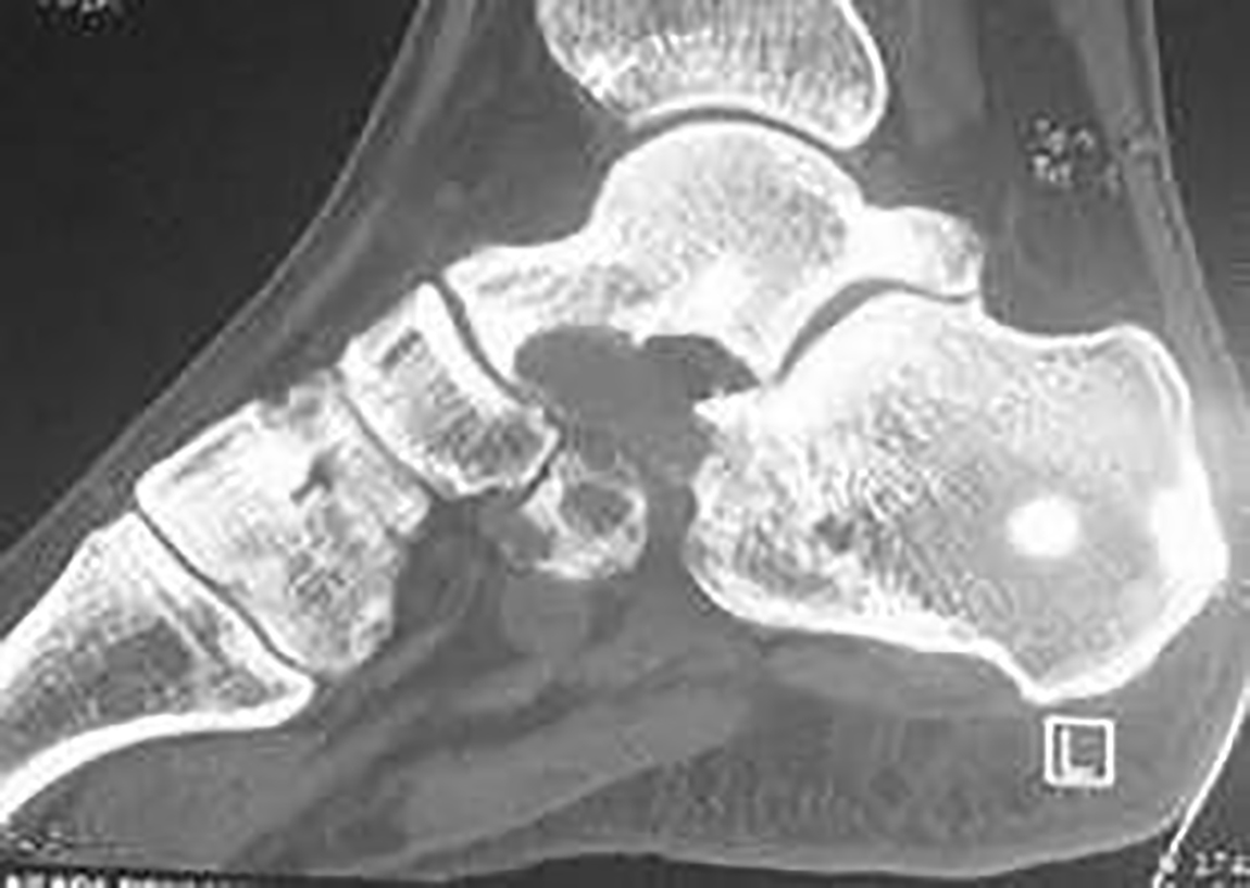 reticulum cell sarcoma x ray