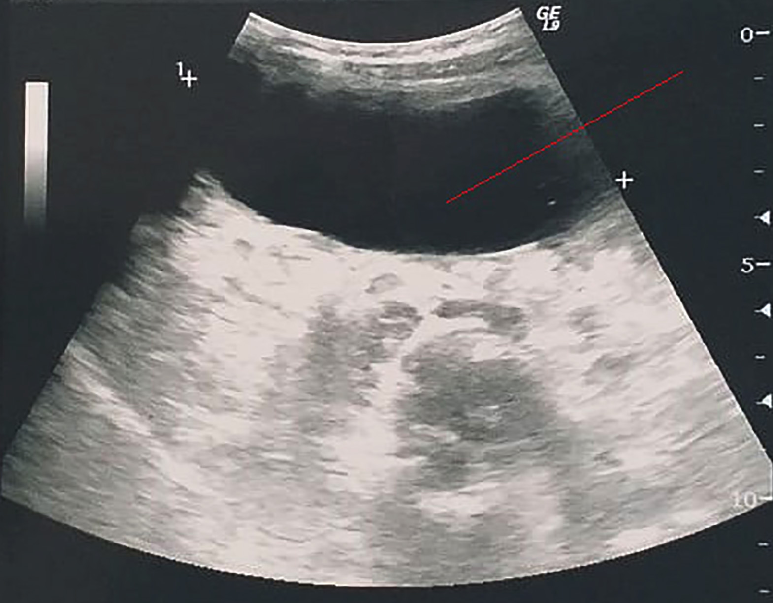 Intraperitoneal rupture of the hydatid cyst: Four case reports and