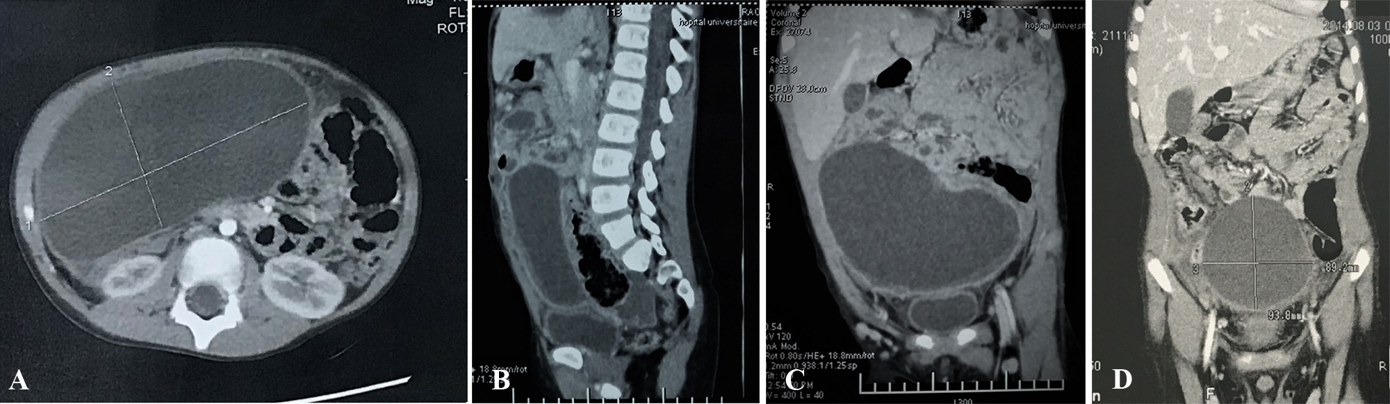 Intraperitoneal rupture of the hydatid cyst: Four case reports and