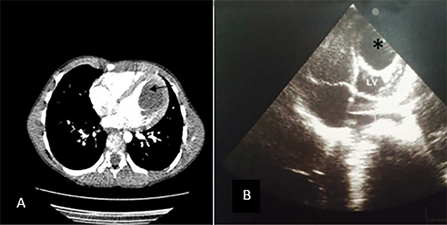 A. Cystic content was haematic. B: Hydatid membranes have the color red