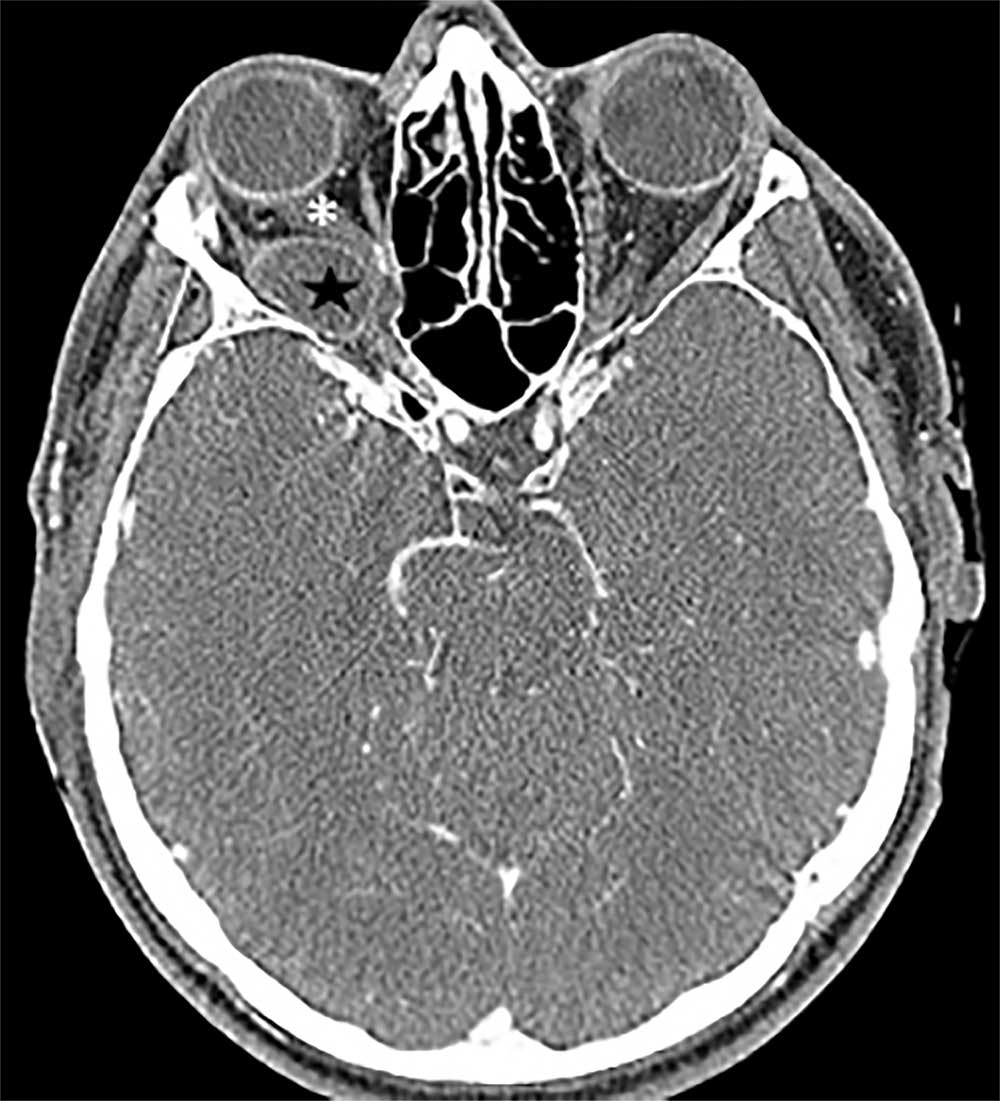 Figure2  Intraventricular Contrast Medium Leakage during Ethanol