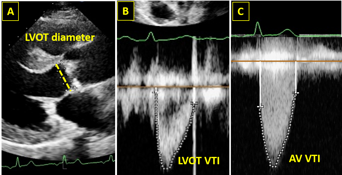 Clinical Applications of Strain Imaging in Aortic Valve Disease