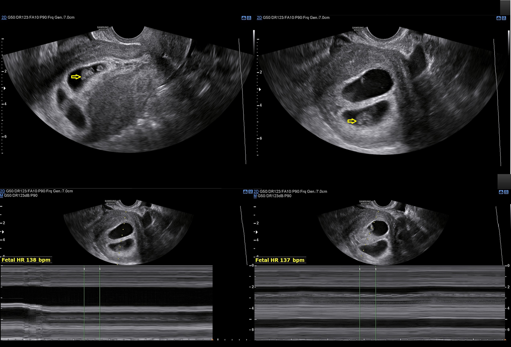 A unique case of diagnosis of a heterotopic pregnancy at 26 weeks