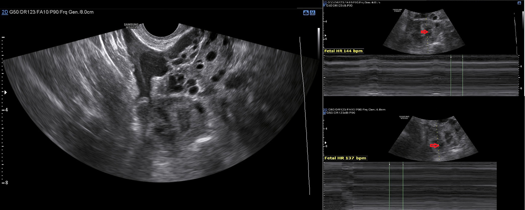 Quadruplet Heterotopic Pregnancy Following In Vitro Fertilization and  Embryo Transfer with Laparotomic Removal of Ruptured Twin Tubal Ectopic  Pregnancy: A Case Report